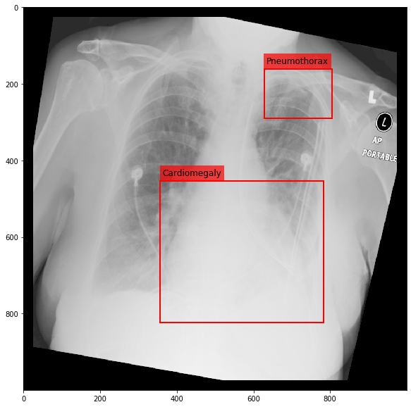 _images/Medical_Data_Augmentation_CXR14_22_8.png